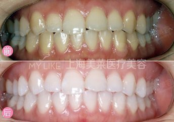 上海色素牙治疗多少钱