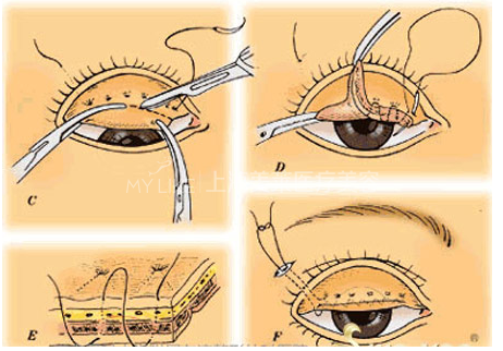 双眼皮修复的方法