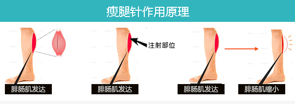 注射瘦腿针示意图