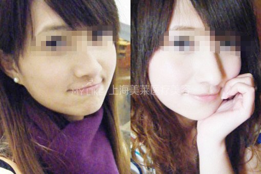 上海美莱打美白针的明显高效