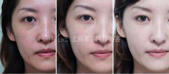 上海美莱美白针能够全身美白吗