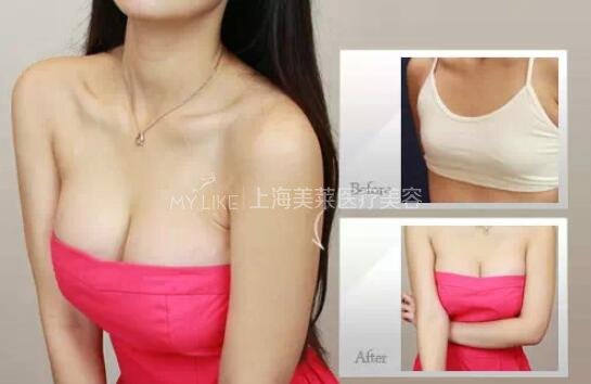 哪家丰胸医院好 如何正确选择