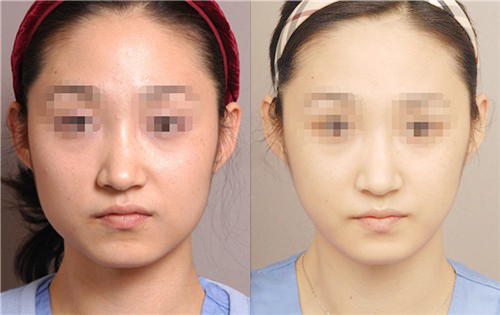 瘦脸针的明显高效如何