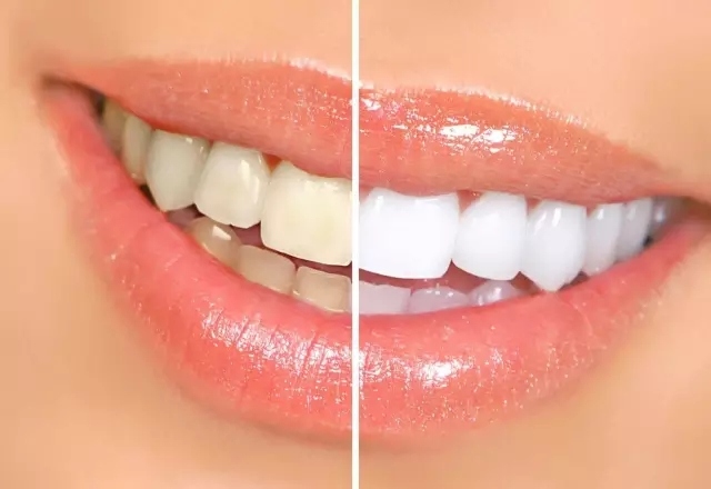 关于洗牙的误区是什么
