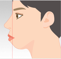 突嘴究竟需不需要做手术?