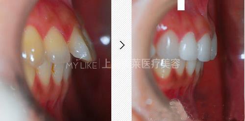 突嘴究竟需不需要做手术?