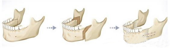 突嘴究竟需不需要做手术?