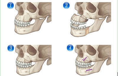 突嘴究竟需不需要做手术?