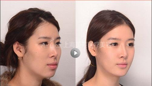 突嘴究竟需不需要做手术?