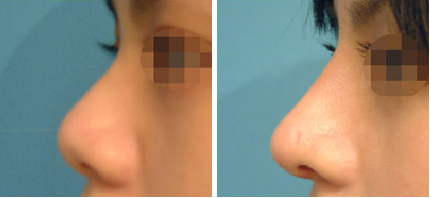 来说说你喜欢注射隆鼻手术的理由是什么