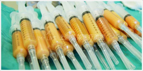 抽脂减肥安全吗 <wbr> <wbr>抽脂术的误区